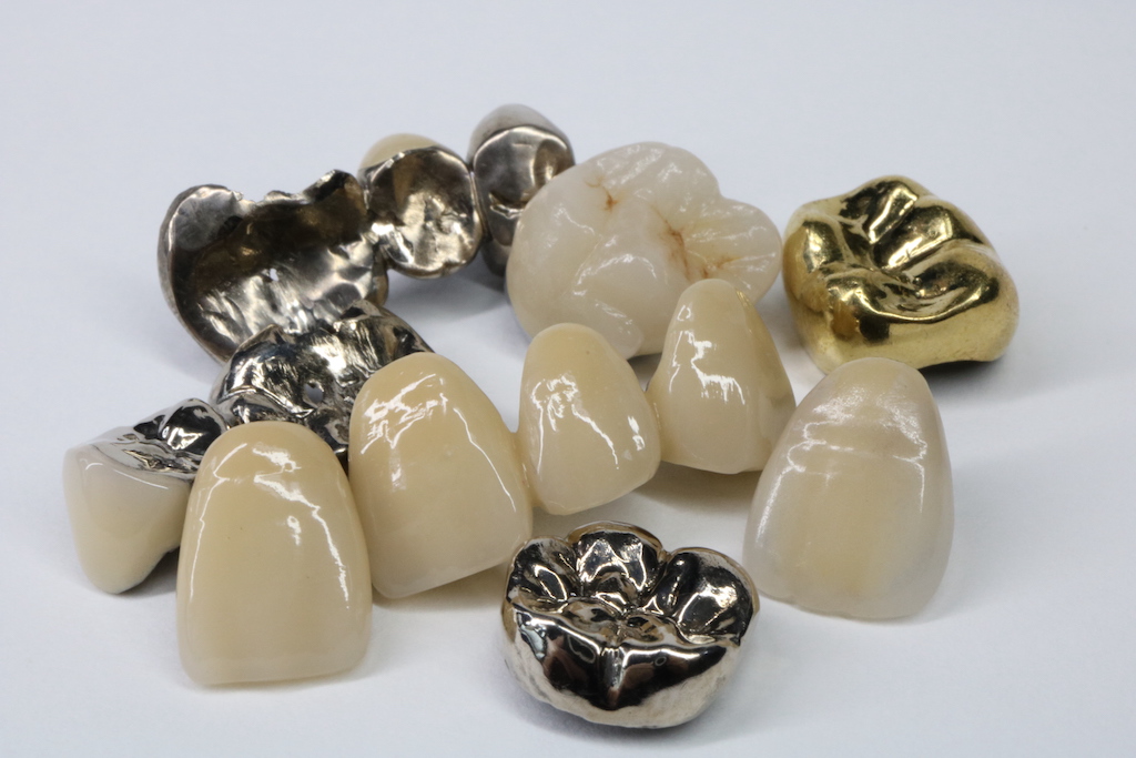 詰め物・被せ物